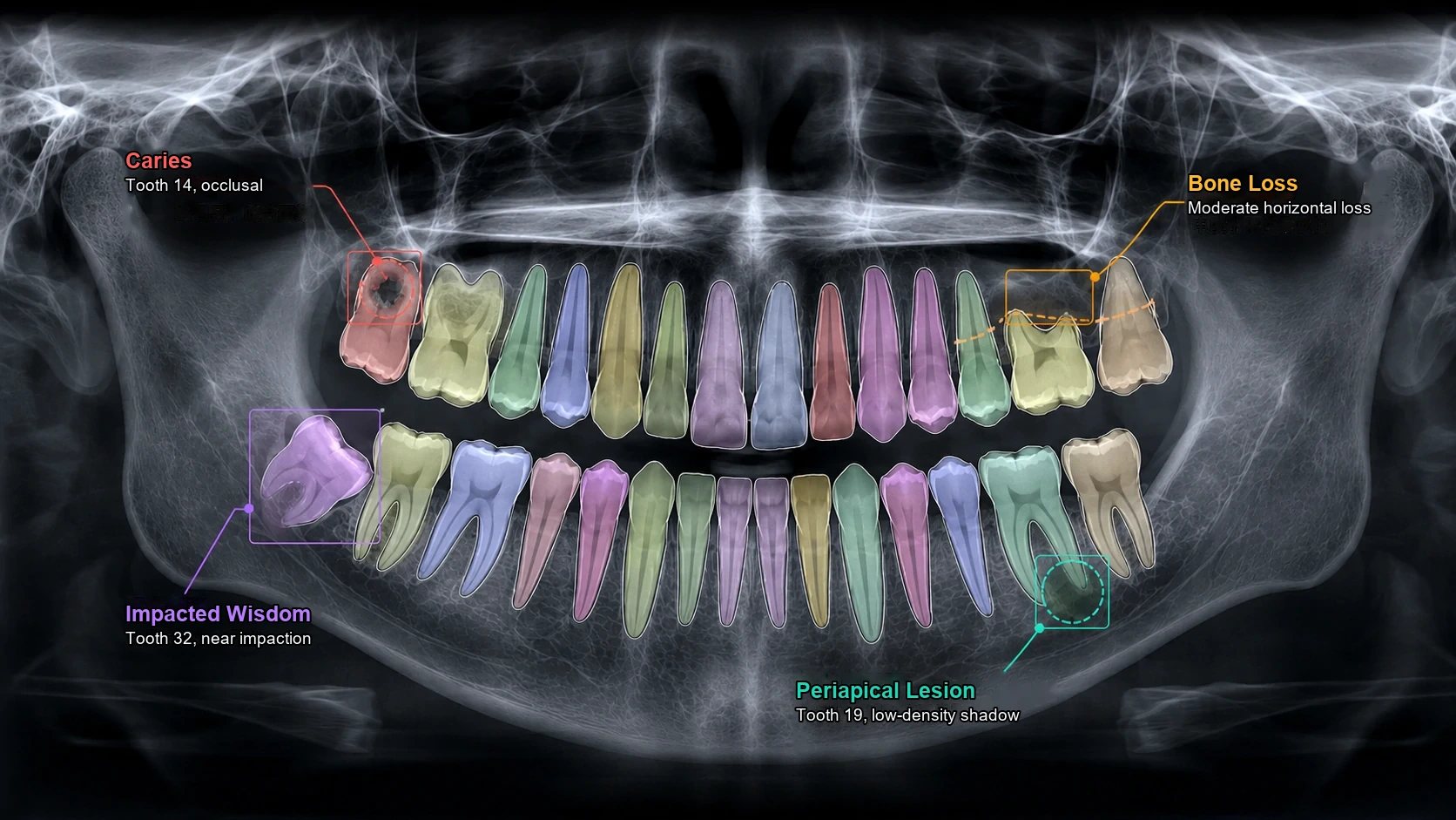 Panoramic X-ray Detection and Segmentation